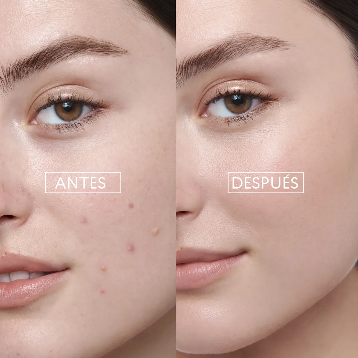 Corrector Localizado Bye Bye Granitos Skin First Cyzone 15g